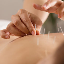 Patient receiving acupuncture treatment.
