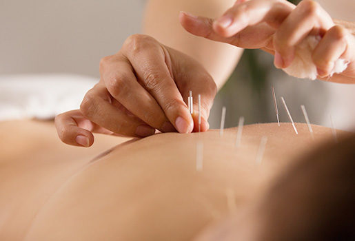 Patient receiving acupuncture treatment.